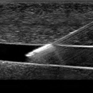 General - Acceso Vascular Con Ultrasonido para Enfermería
