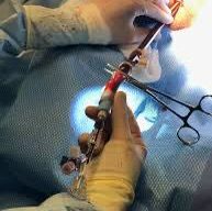 General - Canulación en ECMO